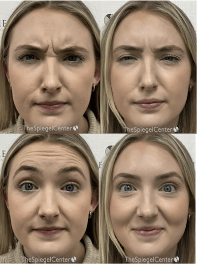 Botox / Dysport / Jeuveau / Xeomin Before & After Gallery - Patient 103490 - Image 1