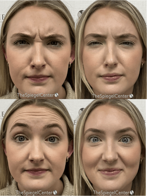 Botox / Dysport / Jeuveau / Xeomin Before & After Gallery - Patient 103490 - Image 1