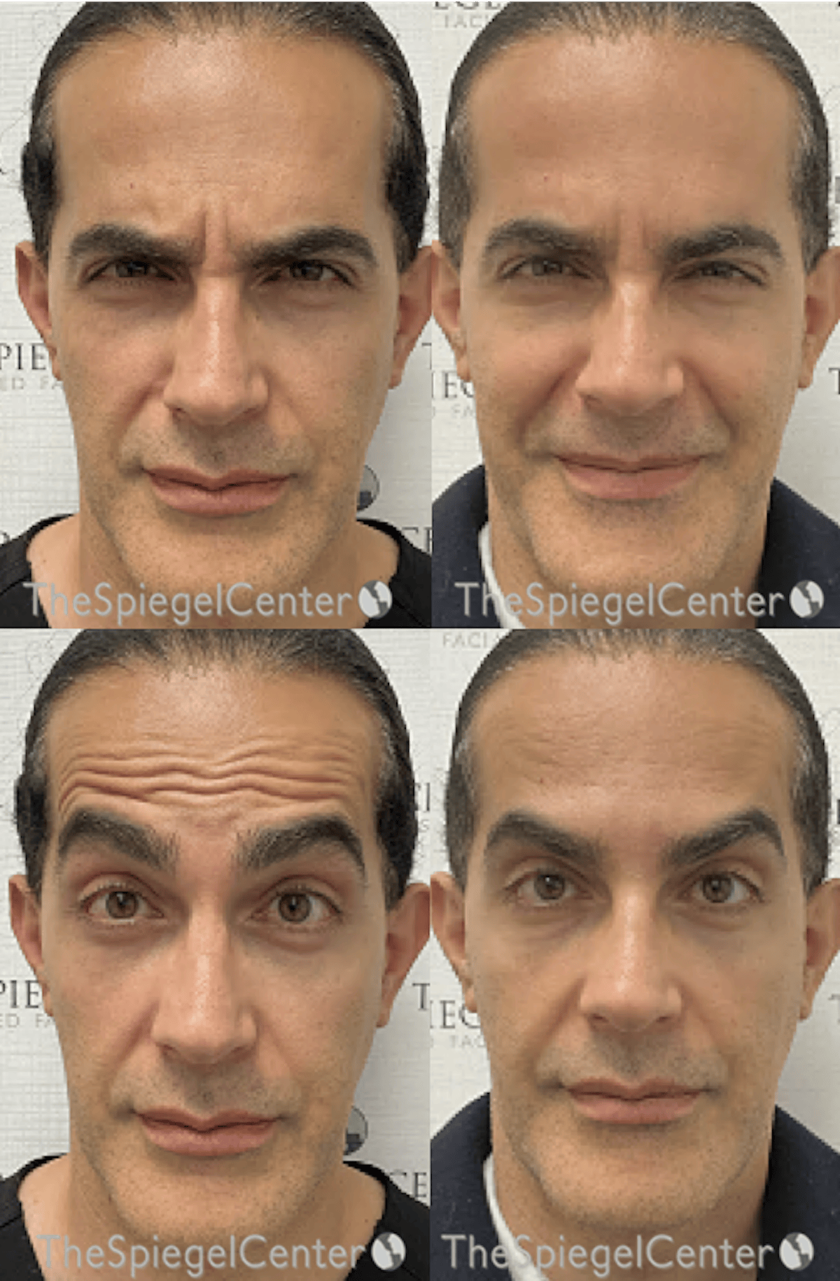 Botox / Dysport / Jeuveau / Xeomin Before & After Gallery - Patient 367003 - Image 1