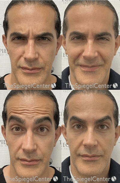 Botox / Dysport / Jeuveau / Xeomin Before & After Gallery - Patient 367003 - Image 1