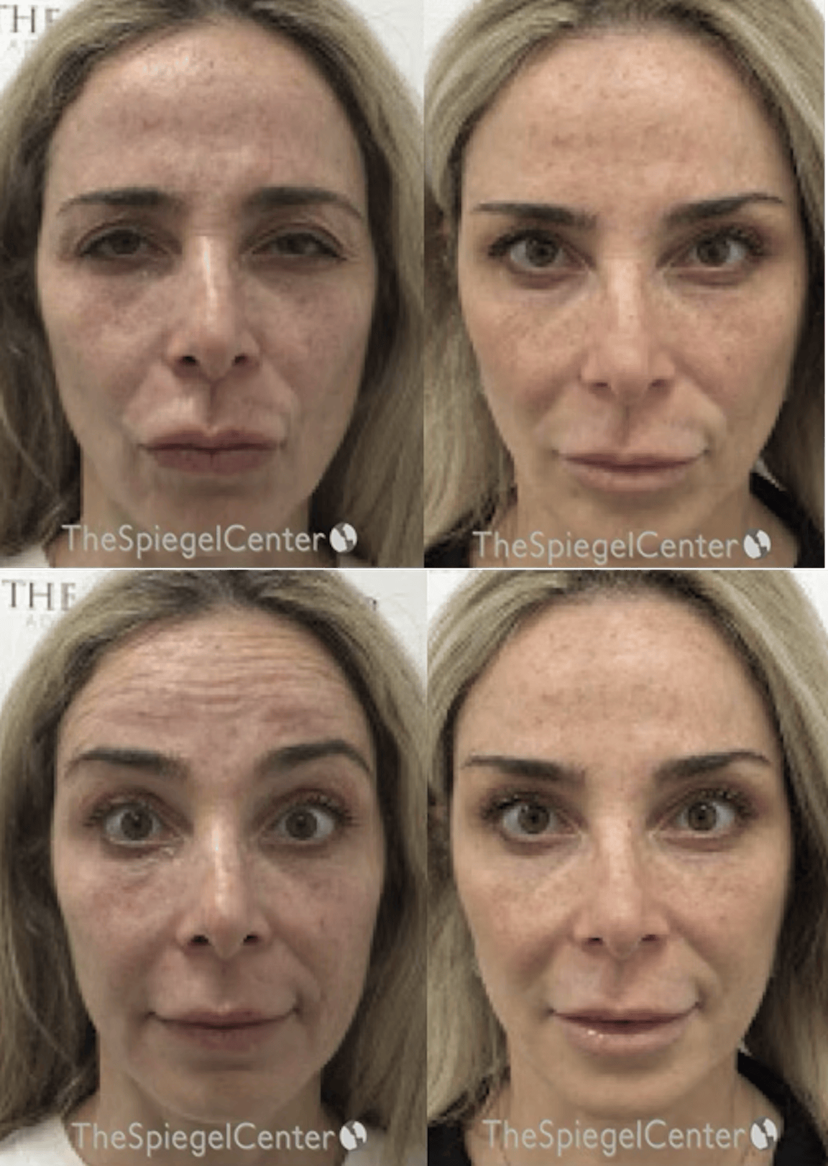 Botox / Dysport / Jeuveau / Xeomin Before & After Gallery - Patient 427913 - Image 1