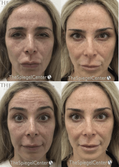 Botox / Dysport / Jeuveau / Xeomin Before & After Gallery - Patient 427913 - Image 1
