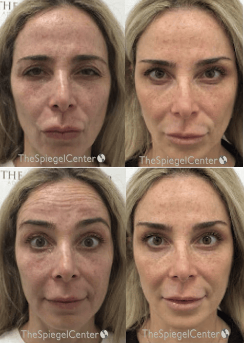 Botox / Dysport / Jeuveau / Xeomin Before & After Gallery - Patient 427913 - Image 1