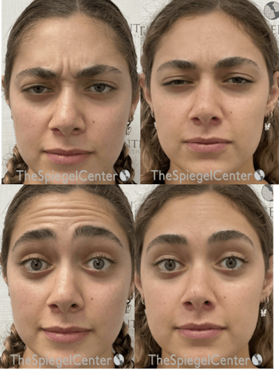 Botox / Dysport / Jeuveau / Xeomin Before & After Gallery - Patient 405647 - Image 1