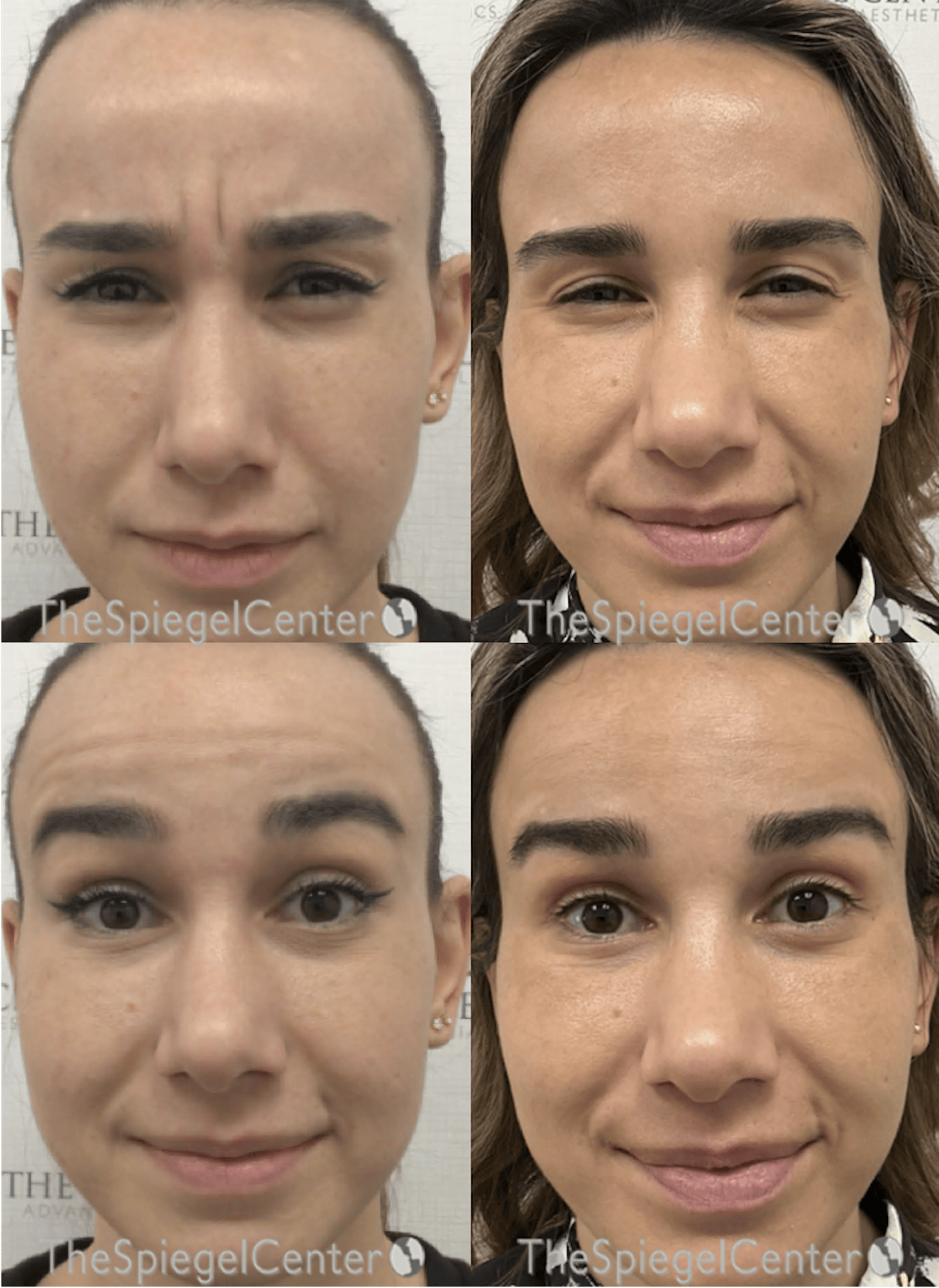Botox / Dysport / Jeuveau / Xeomin Before & After Gallery - Patient 382426 - Image 1