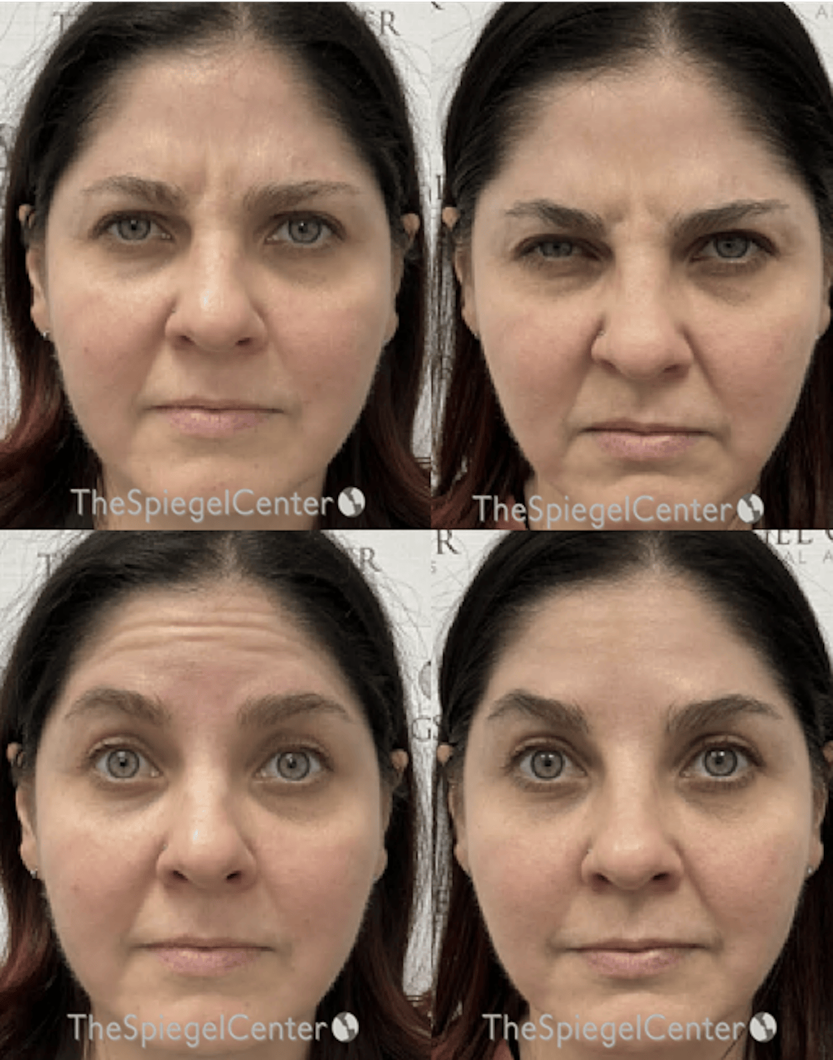 Botox / Dysport / Jeuveau / Xeomin Before & After Gallery - Patient 246587 - Image 1