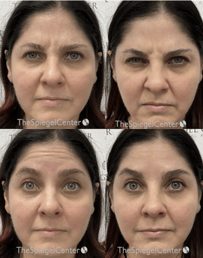 Botox / Dysport / Jeuveau / Xeomin Before & After Gallery - Patient 246587 - Image 1