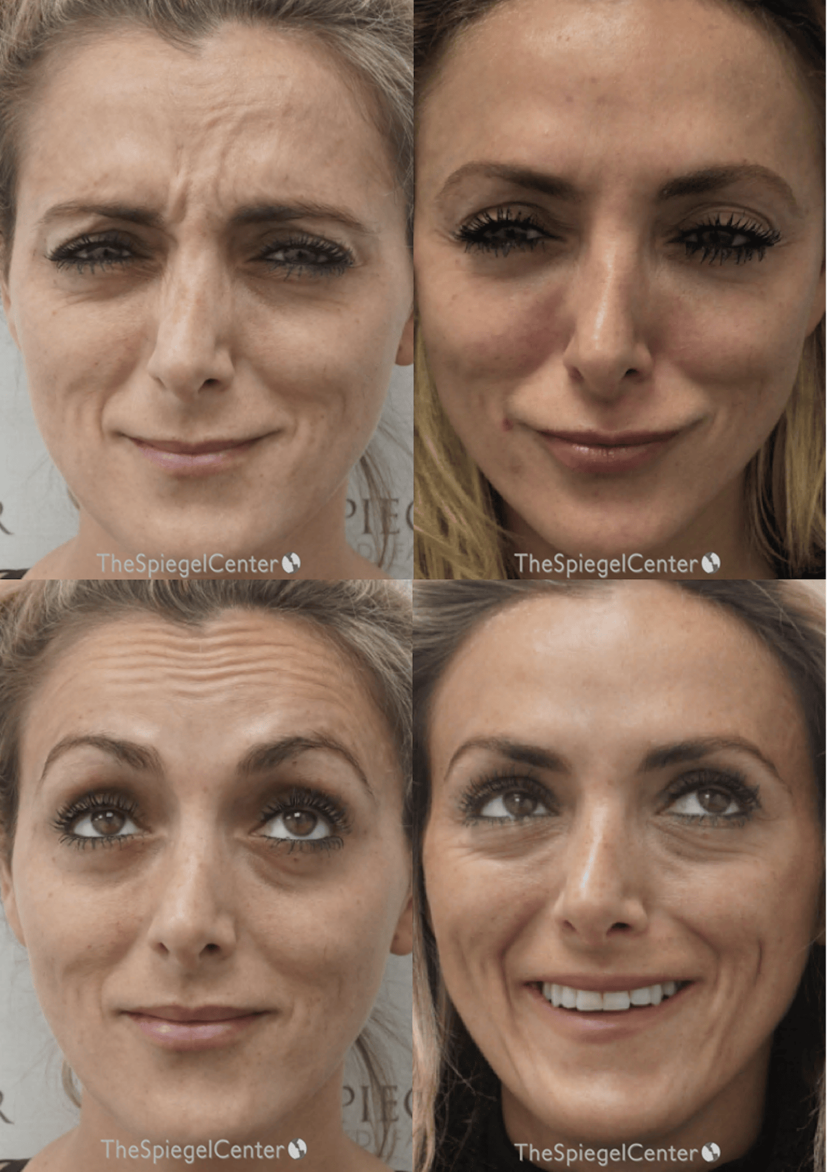 Botox / Dysport / Jeuveau / Xeomin Before & After Gallery - Patient 169149 - Image 1