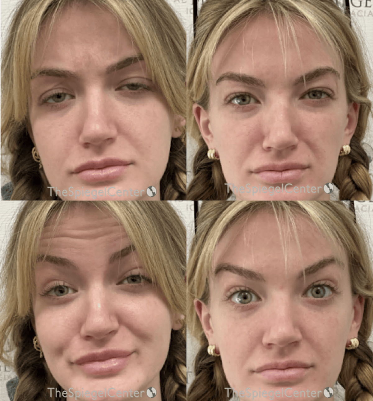 Botox / Dysport / Jeuveau / Xeomin Before & After Gallery - Patient 380953 - Image 1