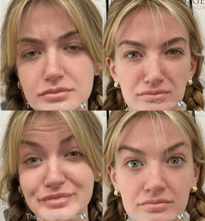 Botox / Dysport / Jeuveau / Xeomin Before & After Gallery - Patient 380953 - Image 1