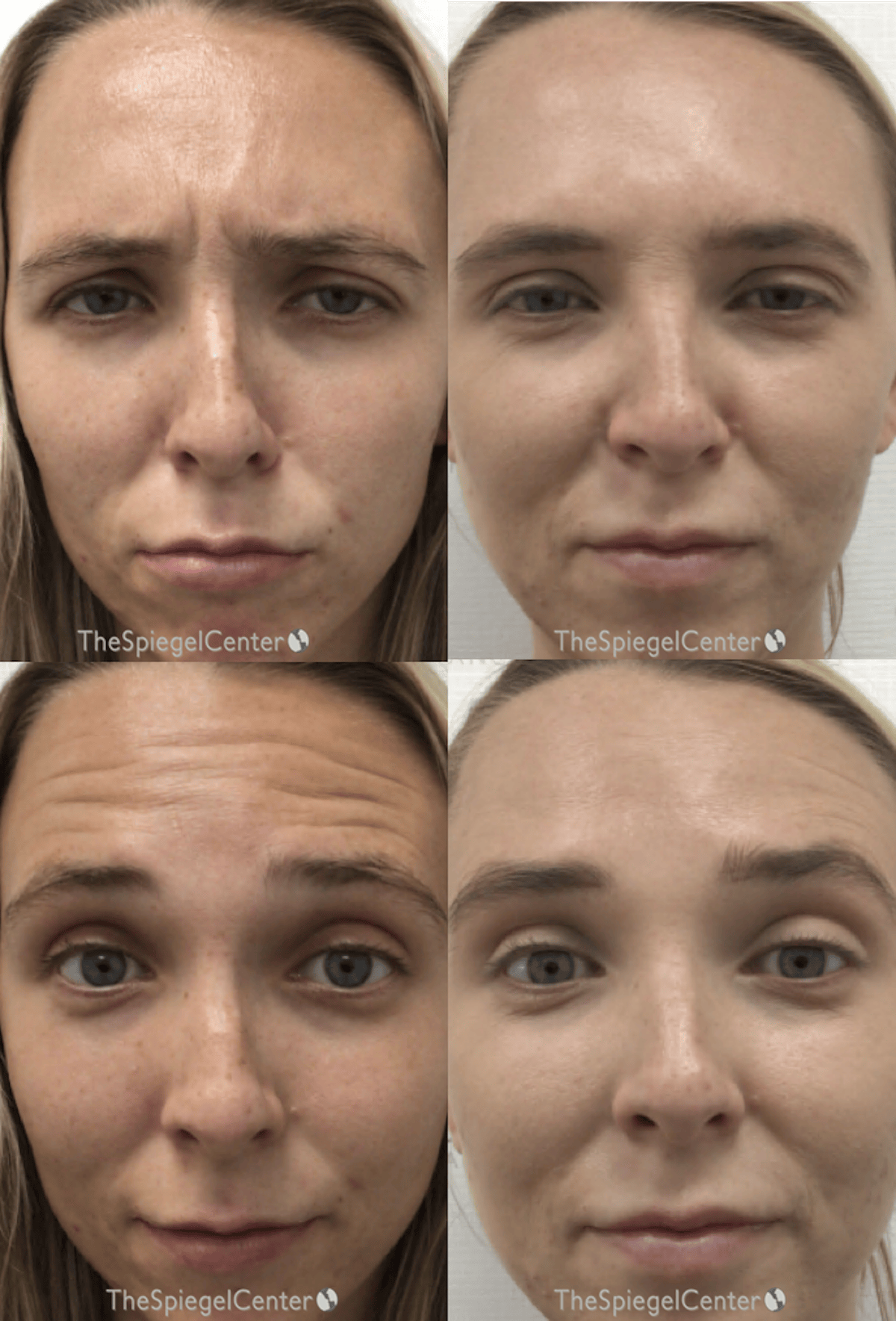 Botox / Dysport / Jeuveau / Xeomin Before & After Gallery - Patient 370042 - Image 1