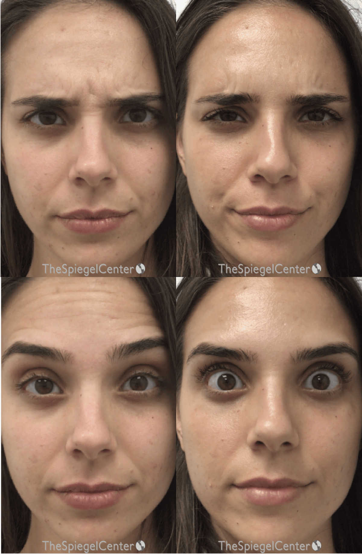 Botox / Dysport / Jeuveau / Xeomin Before & After Gallery - Patient 128347 - Image 1