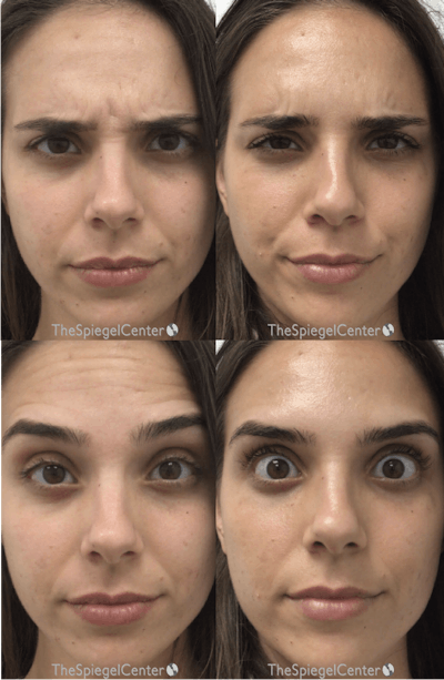 Botox / Dysport / Jeuveau / Xeomin Before & After Gallery - Patient 128347 - Image 1