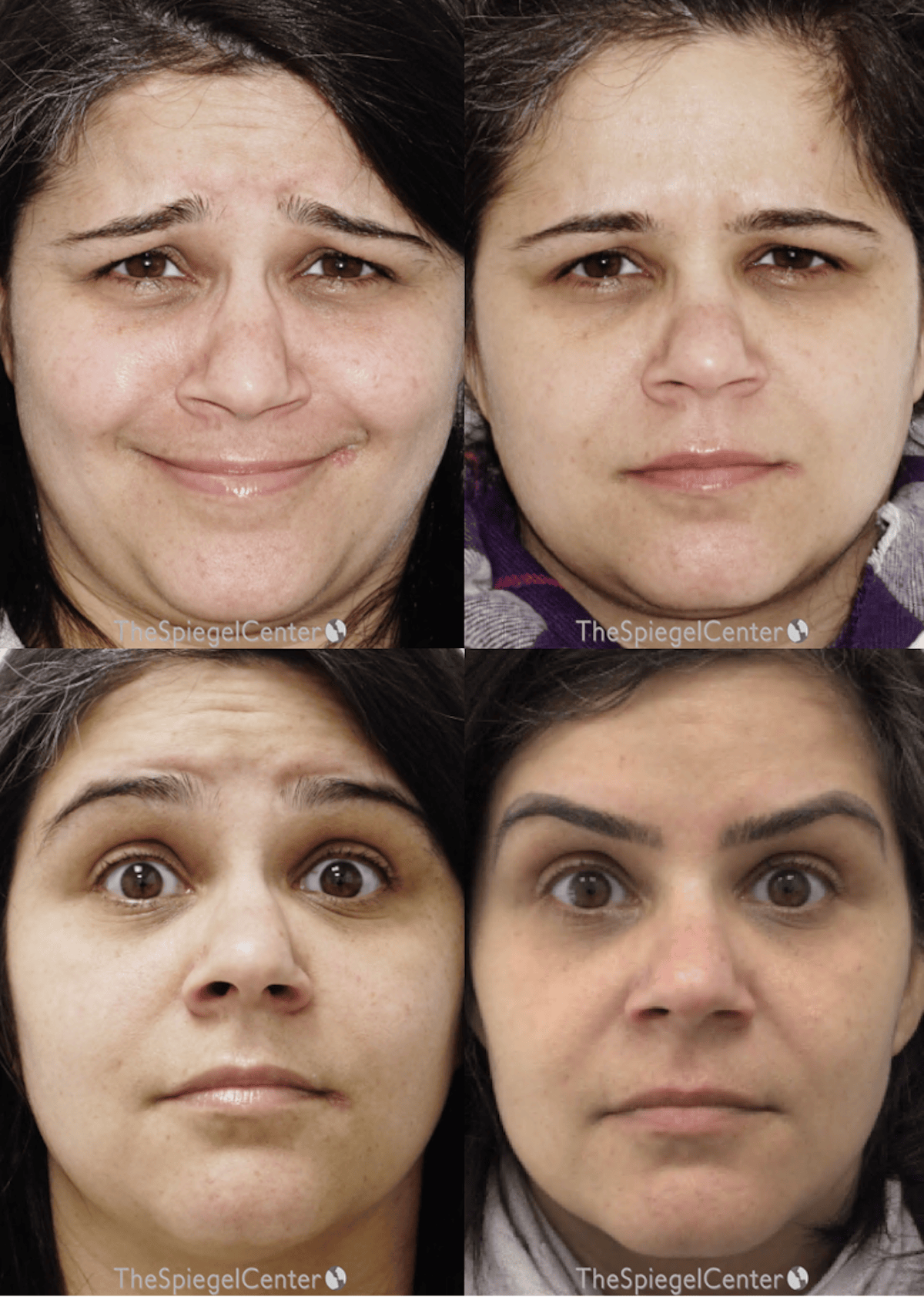 Botox / Dysport / Jeuveau / Xeomin Before & After Gallery - Patient 227328 - Image 1