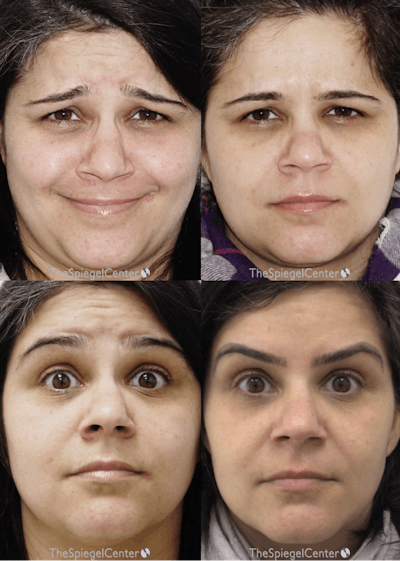 Botox / Dysport / Jeuveau / Xeomin Before & After Gallery - Patient 227328 - Image 1