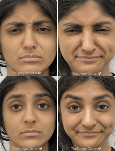 Botox / Dysport / Jeuveau / Xeomin Before & After Gallery - Patient 278530 - Image 1