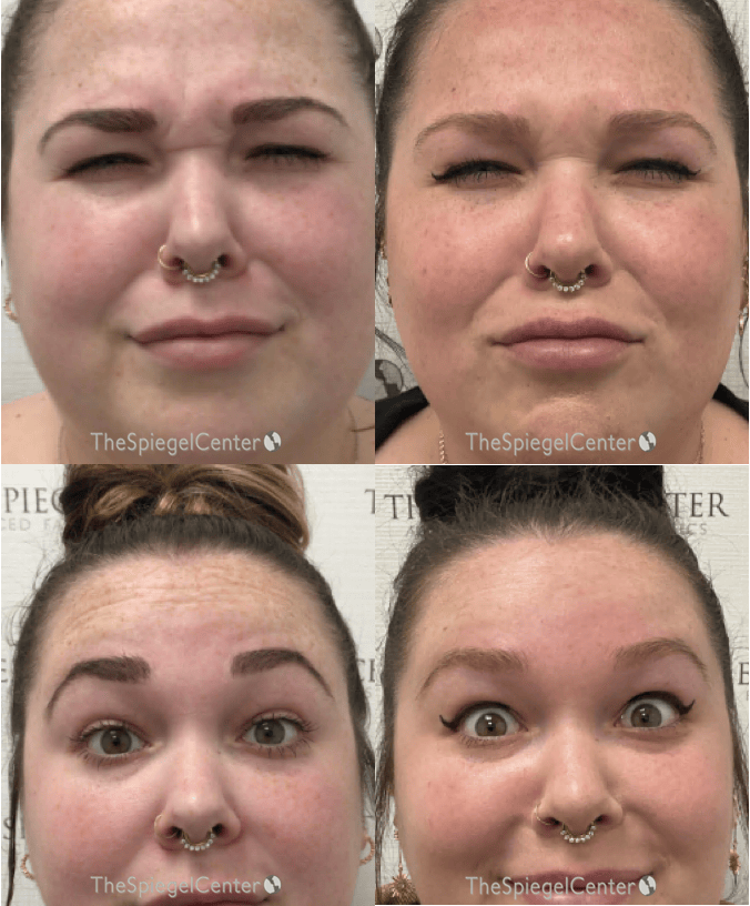 Botox / Dysport / Jeuveau / Xeomin Before & After Gallery - Patient 147283 - Image 1