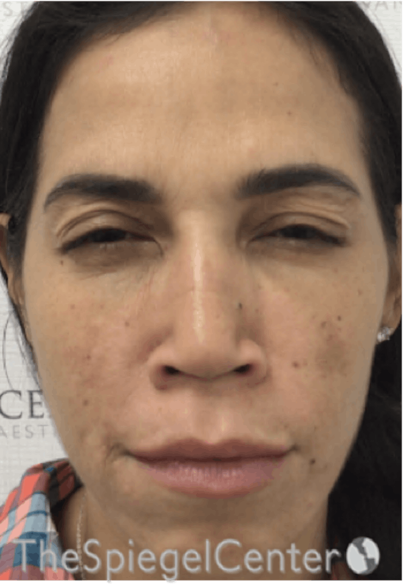 Botox / Dysport / Jeuveau / Xeomin Before & After Gallery - Patient 256182 - Image 2