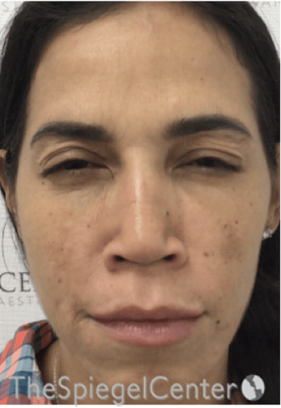 Botox / Dysport / Jeuveau / Xeomin Before & After Gallery - Patient 256182 - Image 2