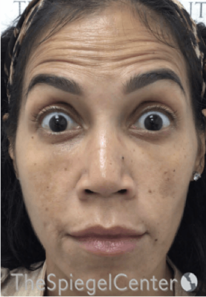 Botox / Dysport / Jeuveau / Xeomin Before & After Gallery - Patient 256182 - Image 3