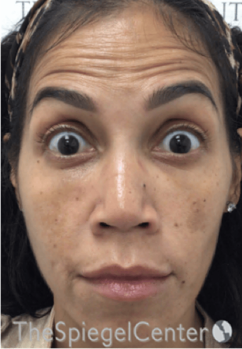 Botox / Dysport / Jeuveau / Xeomin Before & After Gallery - Patient 256182 - Image 3