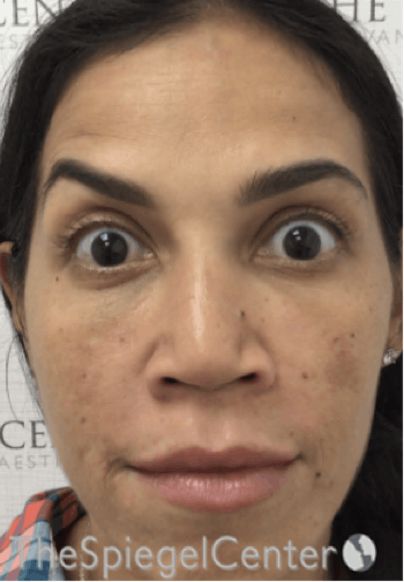 Botox / Dysport / Jeuveau / Xeomin Before & After Gallery - Patient 256182 - Image 4