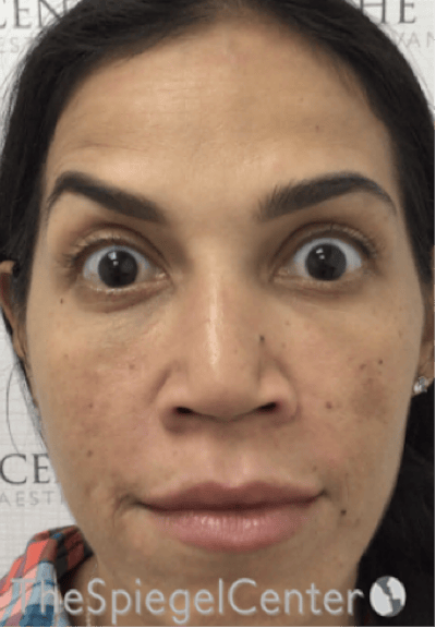Botox / Dysport / Jeuveau / Xeomin Before & After Gallery - Patient 256182 - Image 4