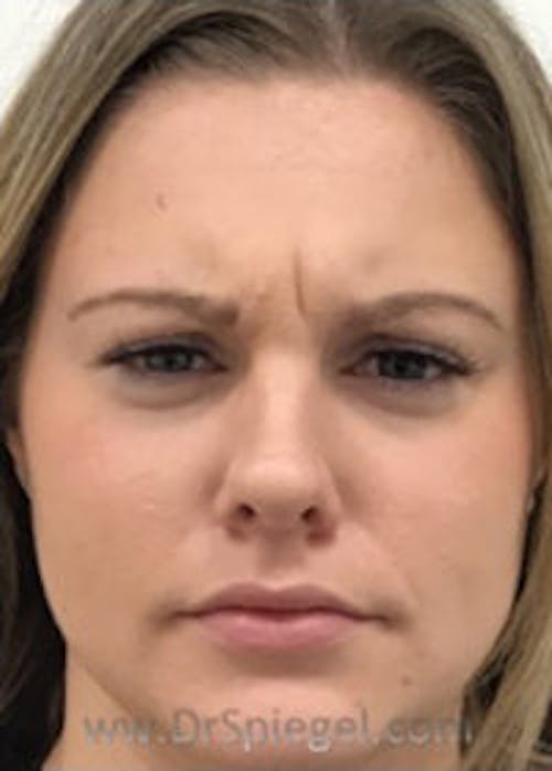 Botox / Dysport / Jeuveau / Xeomin Before & After Gallery - Patient 148072 - Image 1