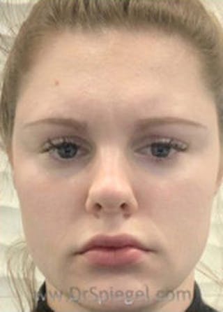 Botox / Dysport / Jeuveau / Xeomin Before & After Gallery - Patient 148072 - Image 2