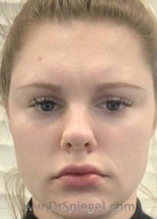 Botox / Dysport / Jeuveau / Xeomin Before & After Gallery - Patient 148072 - Image 2