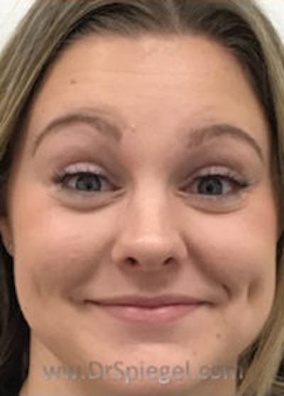 Botox / Dysport / Jeuveau / Xeomin Before & After Gallery - Patient 148072 - Image 3