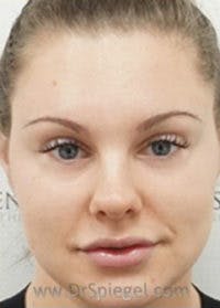 Botox / Dysport / Jeuveau / Xeomin Before & After Gallery - Patient 148072 - Image 4
