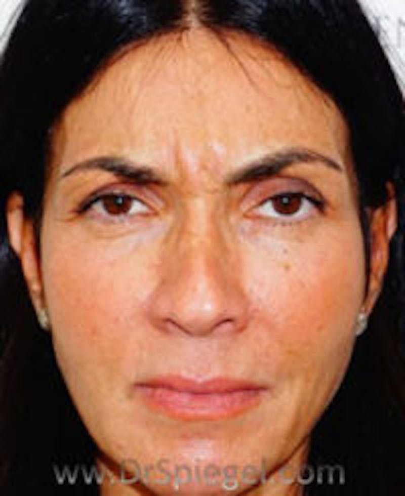 Botox / Dysport / Jeuveau / Xeomin Before & After Gallery - Patient 234478 - Image 1
