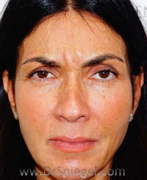 Botox / Dysport / Jeuveau / Xeomin Before & After Gallery - Patient 234478 - Image 1