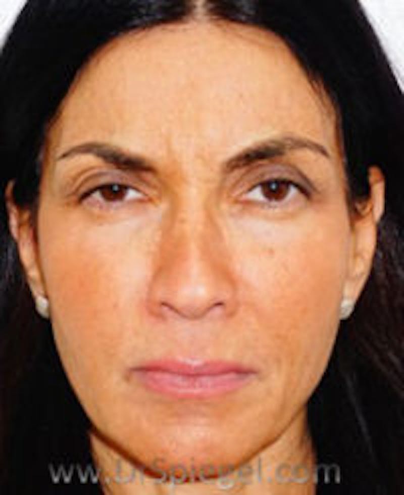 Botox / Dysport / Jeuveau / Xeomin Before & After Gallery - Patient 234478 - Image 2