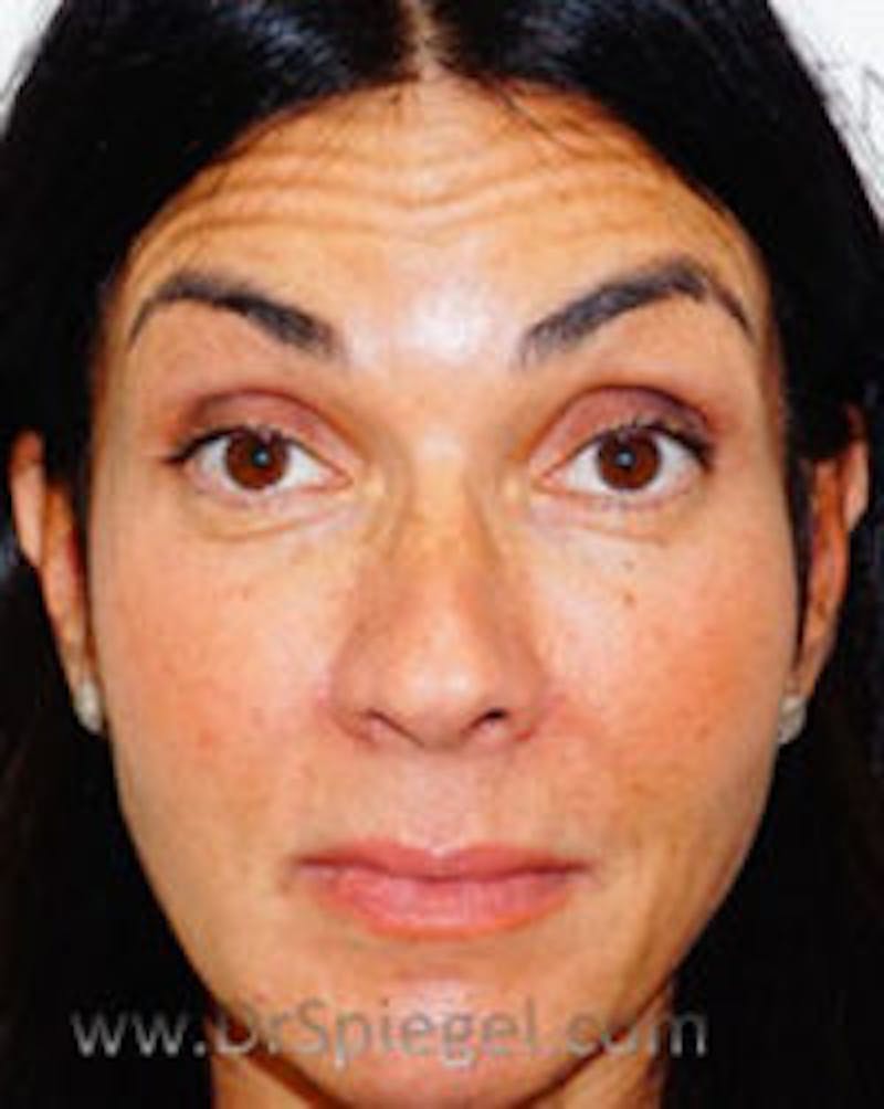 Botox / Dysport / Jeuveau / Xeomin Before & After Gallery - Patient 234478 - Image 3