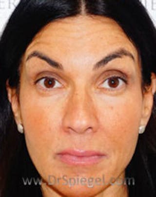 Botox / Dysport / Jeuveau / Xeomin Before & After Gallery - Patient 234478 - Image 4