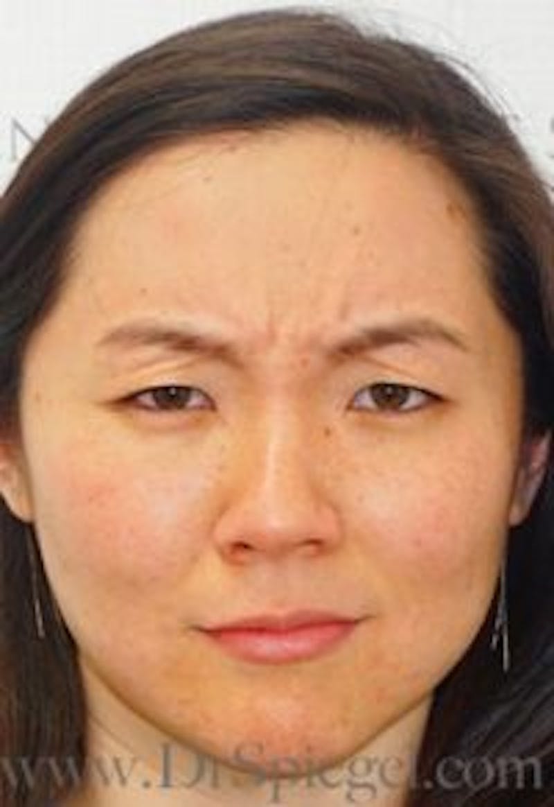 BOTOX/Dysport/Jeuveau/Xeomin Before & After Gallery - Patient 280245 - Image 1