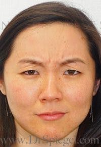 Botox / Dysport / Jeuveau / Xeomin Before & After Gallery - Patient 370882 - Image 1