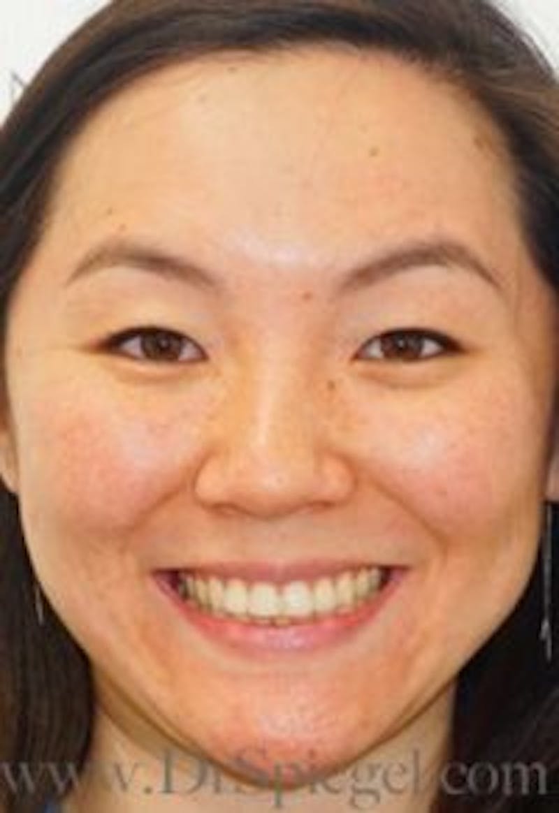 BOTOX/Dysport/Jeuveau/Xeomin Before & After Gallery - Patient 280245 - Image 3