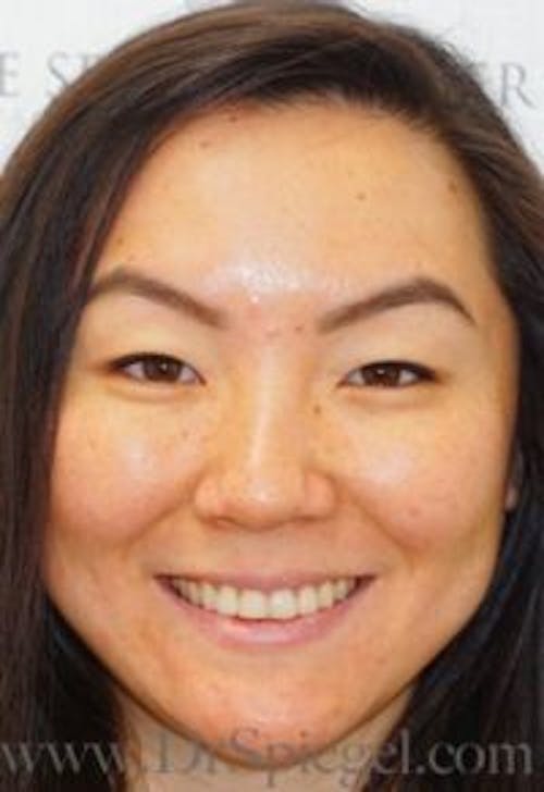 Botox / Dysport / Jeuveau / Xeomin Before & After Gallery - Patient 370882 - Image 4