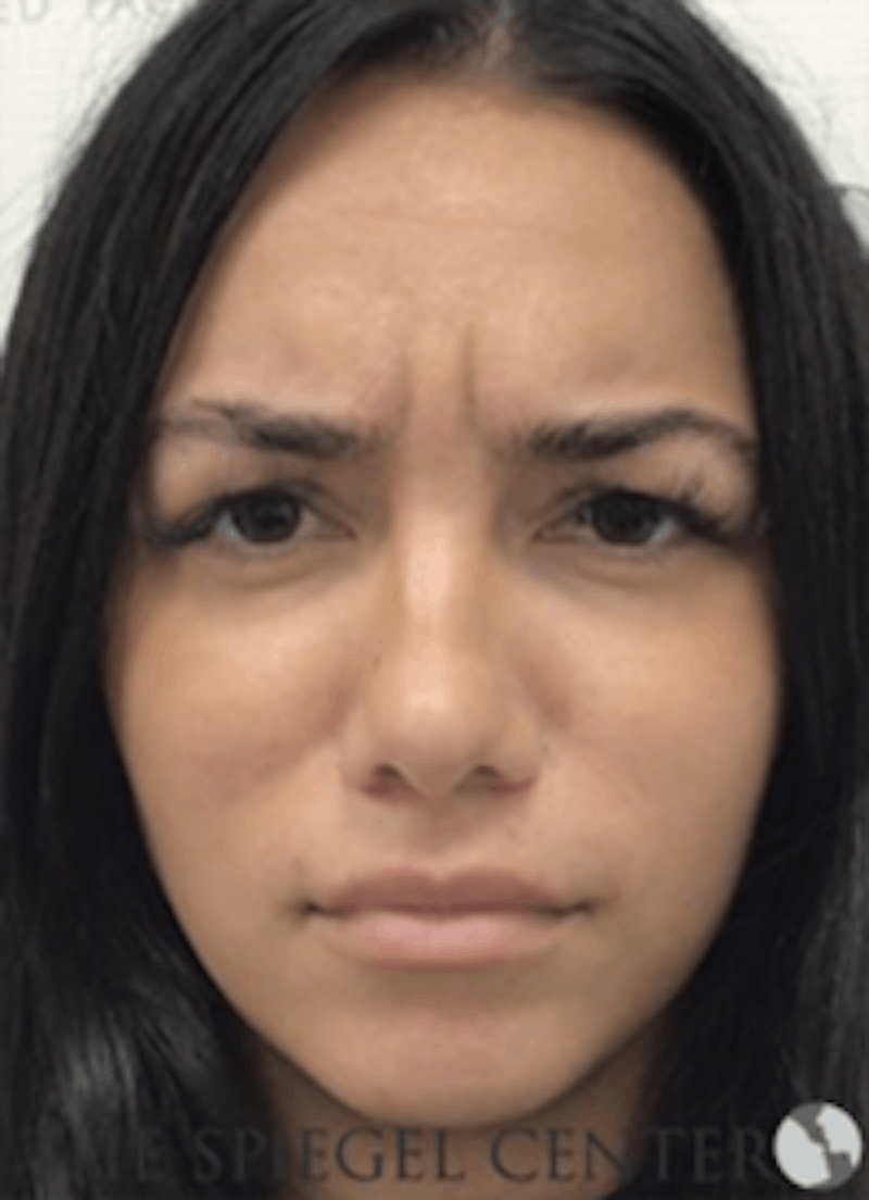 Botox / Dysport / Jeuveau / Xeomin Before & After Gallery - Patient 373037 - Image 1