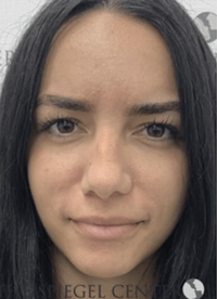 Botox / Dysport / Jeuveau / Xeomin Before & After Gallery - Patient 373037 - Image 2