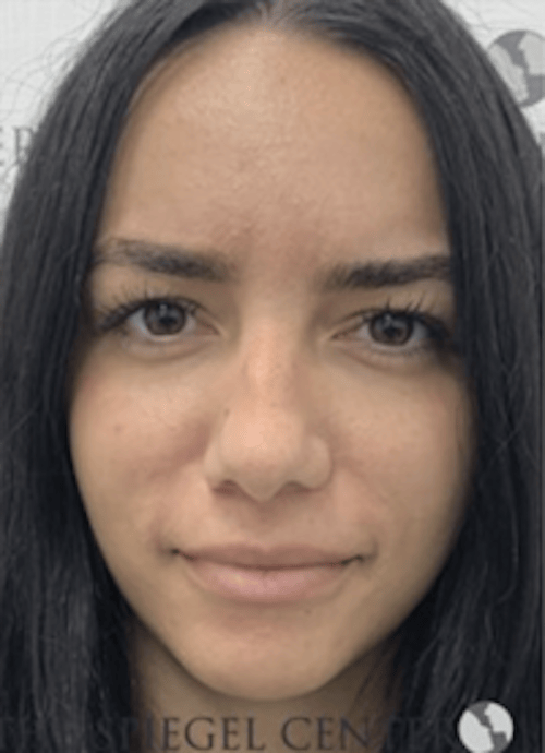 Botox / Dysport / Jeuveau / Xeomin Before & After Gallery - Patient 373037 - Image 2