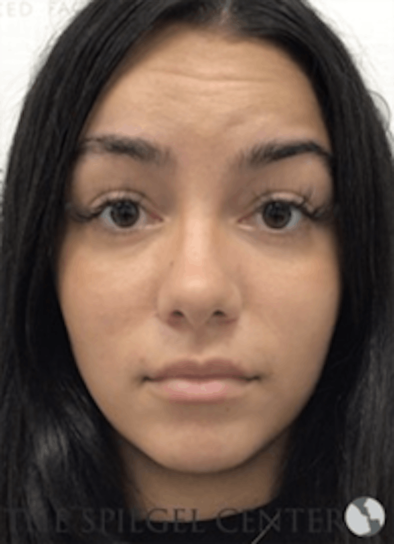 Botox / Dysport / Jeuveau / Xeomin Before & After Gallery - Patient 373037 - Image 3