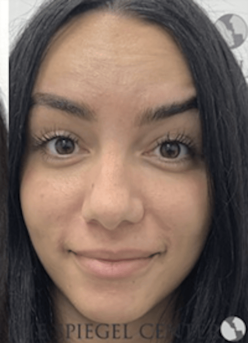 Botox / Dysport / Jeuveau / Xeomin Before & After Gallery - Patient 373037 - Image 4