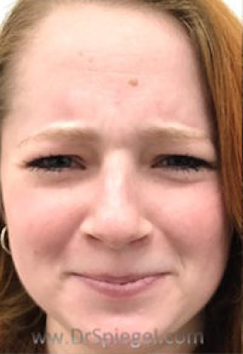 Botox / Dysport / Jeuveau / Xeomin Before & After Gallery - Patient 364862 - Image 1