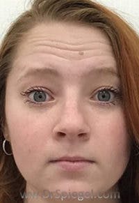 Botox / Dysport / Jeuveau / Xeomin Before & After Gallery - Patient 364862 - Image 3