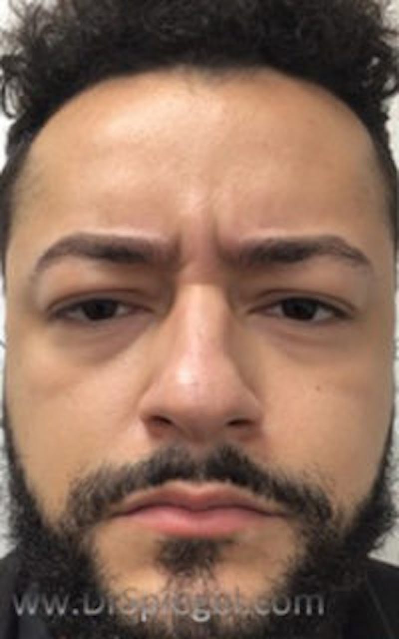 Botox / Dysport / Jeuveau / Xeomin Before & After Gallery - Patient 290673 - Image 1