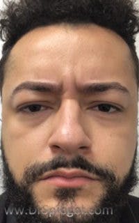 Botox / Dysport / Jeuveau / Xeomin Before & After Gallery - Patient 290673 - Image 1